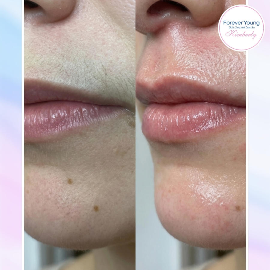 Lip Color Enhancement Treatment